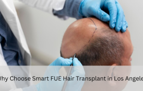smart fue hair transplant in Los Angeles